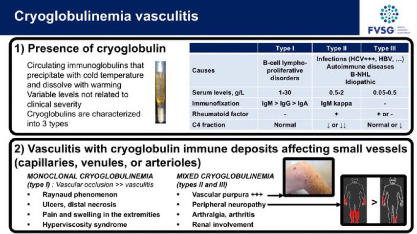 Diagnosis of cryoglobulinemia vasculitis - French Vasculitis Study Group #vasculitis #cryoglobulin #FVSG #GFEV