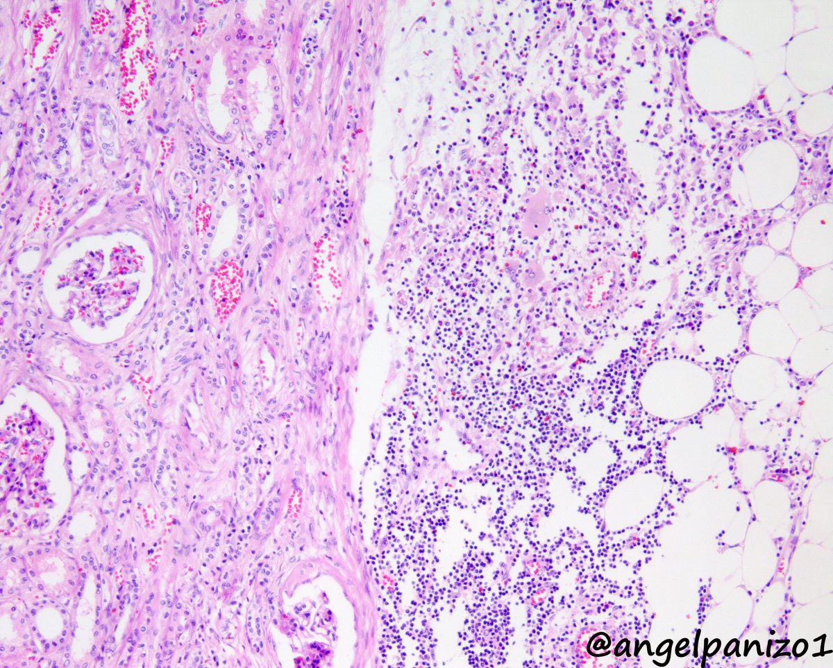 angelpanizo1's tweet photo. Kidney tumor with an "unexpected traveling companion" (1) #gupath @LuizMiguelN @AkgulMd @Williamson_SR @A_Morini_MD @JoaoPedroLobo89 @slusagar @pepeheffernan @nucleololailo https://t.co/CYiNRyJeDZ