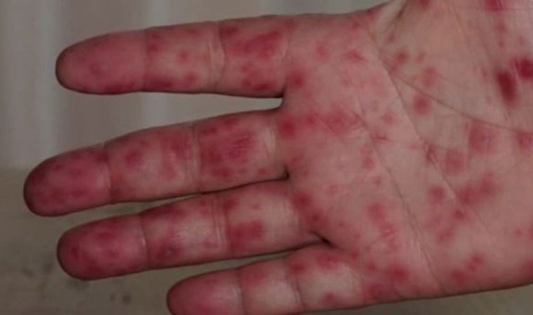 82 çocukta tespit edildi

Korkutan yeni bir salgın daha...
cmhr.yt/irdF