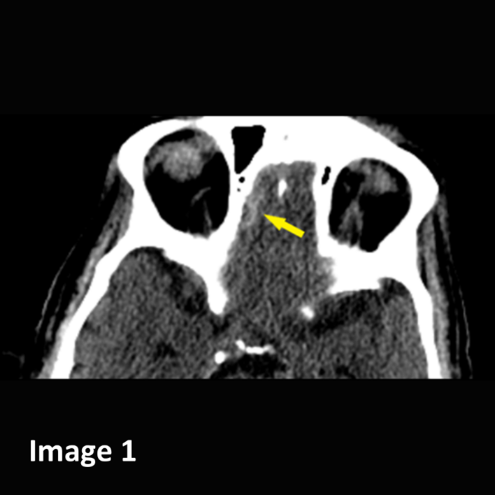 vRad's tweet photo. Great call by a vRad #radiologist on a #CT Head in a patient with acute trauma. Dr. M identified a very small hemorrhagic contusion in the inferior right frontal lobe. A follow up CT Head demonstrated interval enlargement of the hemorrhagic contusion.

#cthead #neuro https://t.co/LrQ97jBH85