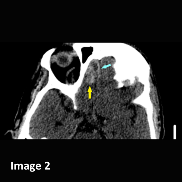 vRad's tweet photo. Great call by a vRad #radiologist on a #CT Head in a patient with acute trauma. Dr. M identified a very small hemorrhagic contusion in the inferior right frontal lobe. A follow up CT Head demonstrated interval enlargement of the hemorrhagic contusion.

#cthead #neuro https://t.co/LrQ97jBH85
