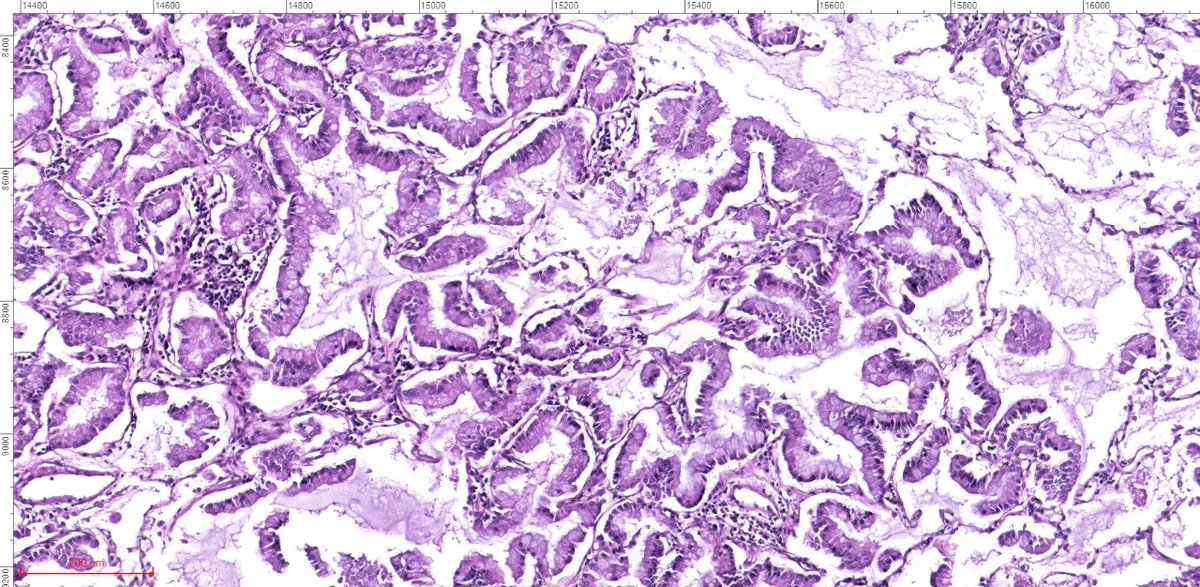 fabiotavora's tweet image. Just had a similar case (no cytology) on resection. Pictures below. These tumors are so mysterious to me. How come they maintain so much respect for the alveoli, and at the same time be so aggressive? #pulmonarypath