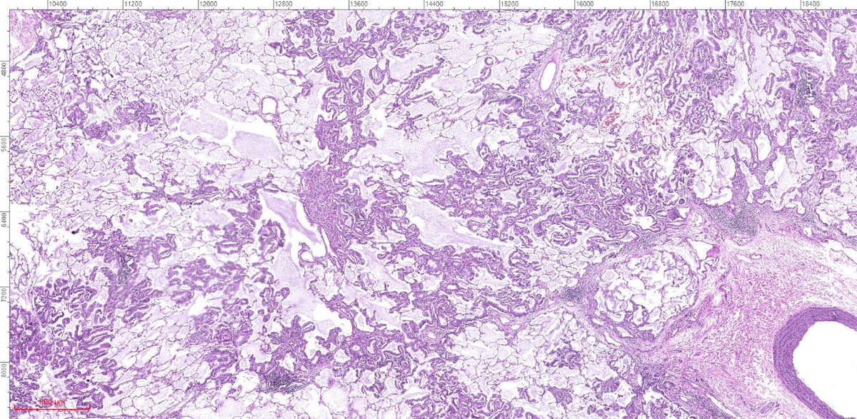 fabiotavora's tweet image. Just had a similar case (no cytology) on resection. Pictures below. These tumors are so mysterious to me. How come they maintain so much respect for the alveoli, and at the same time be so aggressive? #pulmonarypath