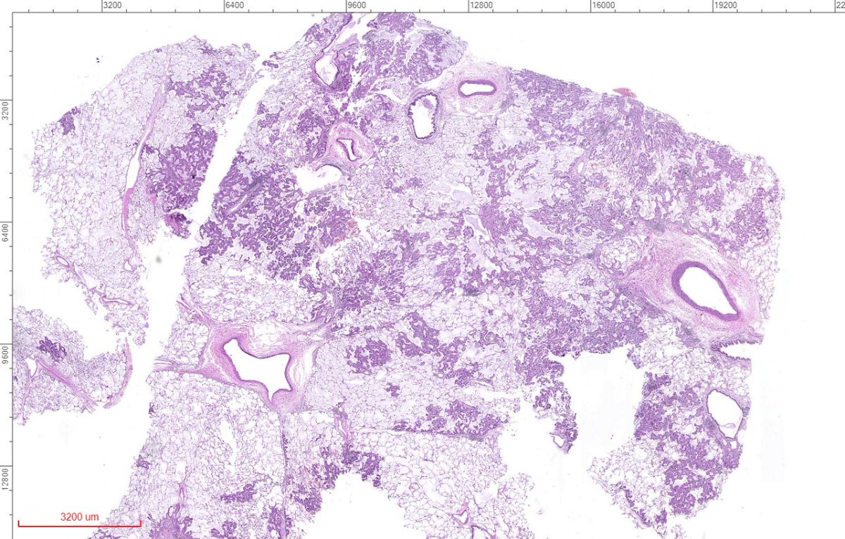 fabiotavora's tweet image. Just had a similar case (no cytology) on resection. Pictures below. These tumors are so mysterious to me. How come they maintain so much respect for the alveoli, and at the same time be so aggressive? #pulmonarypath