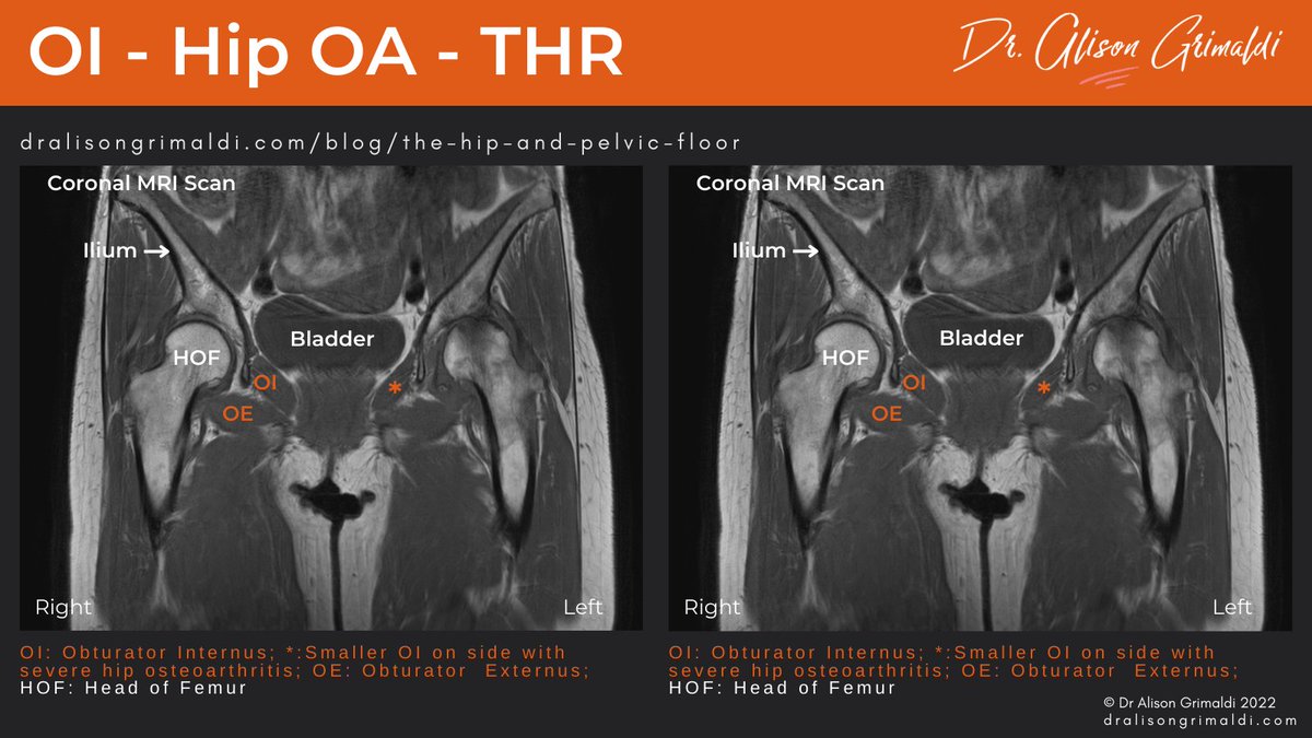 alisongrimaldi's tweet photo. What is the link between hip OA and urinary incontinence? Some suggest that atrophy of OI in those with OA adversely impacts pelvic floor function. Interestingly, UI may improve after THR.
Read more in this month's blog: https://t.co/AwPEw9OfI1 https://t.co/sTA5npIMES