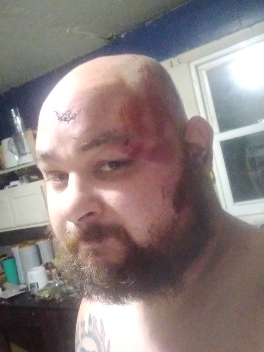 TheDevilPDP's tweet photo. Sorry if I become unavailable I was in a serious accident yesterday showing some aftermath of my face. https://t.co/Mb6GcDDIaT