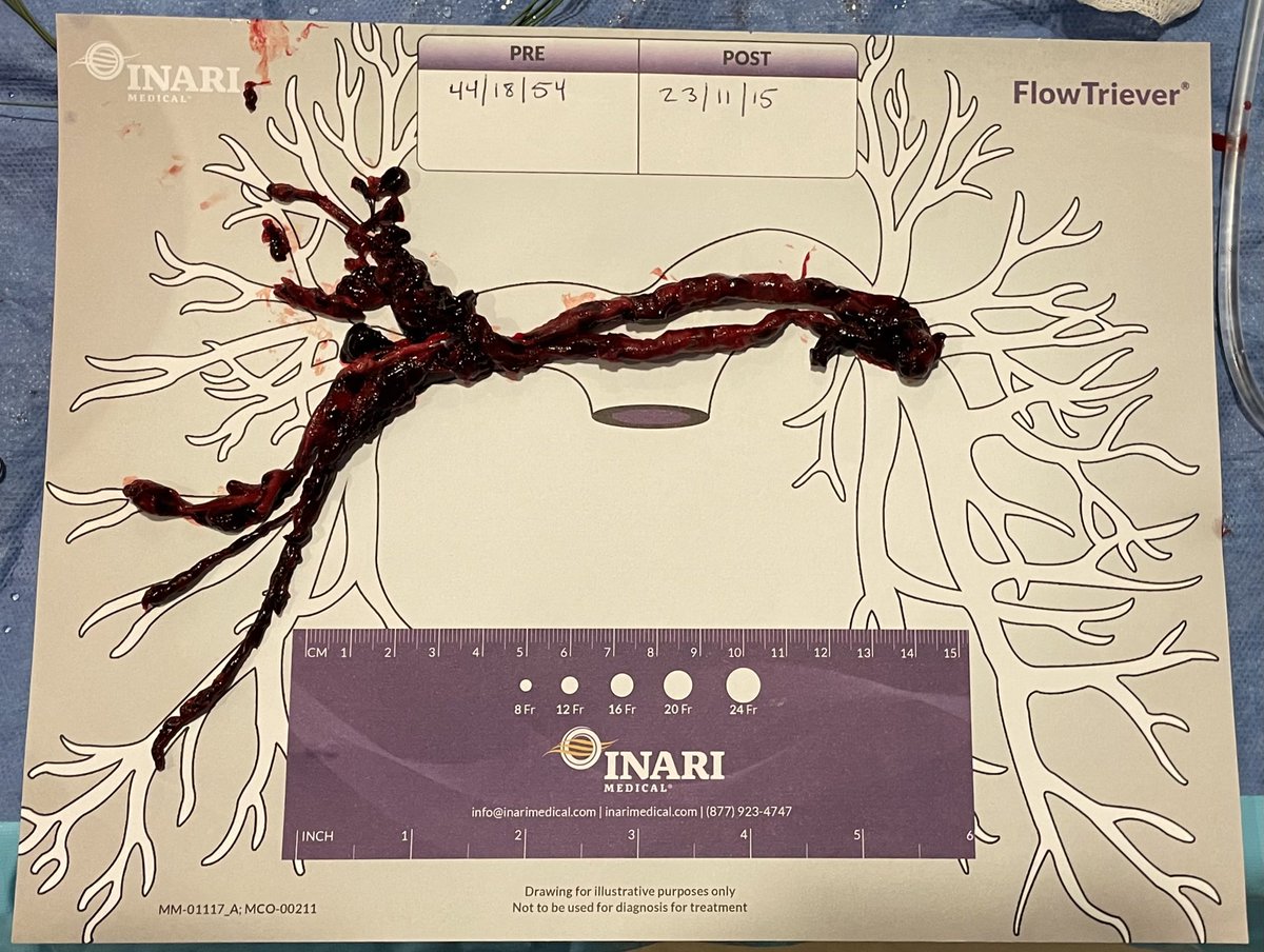 ElBBMD's tweet photo. 78 yo 👩 with lightheadedness and chest tightness, became hypoxic quickly with BP 90/65 ➡️ saddle PE on CTA, elevated Troponin, 1.8 RV/LV ratio ➡️ Cathlab  #INARI ➡️ off oxygen, BP 127/64, HR 82, mPAP 15! @PERTConsortium @AntoniousAttall @DrJayMohan #PulmonaryEmbolism #ACCFIT https://t.co/AFi2iHrGoy