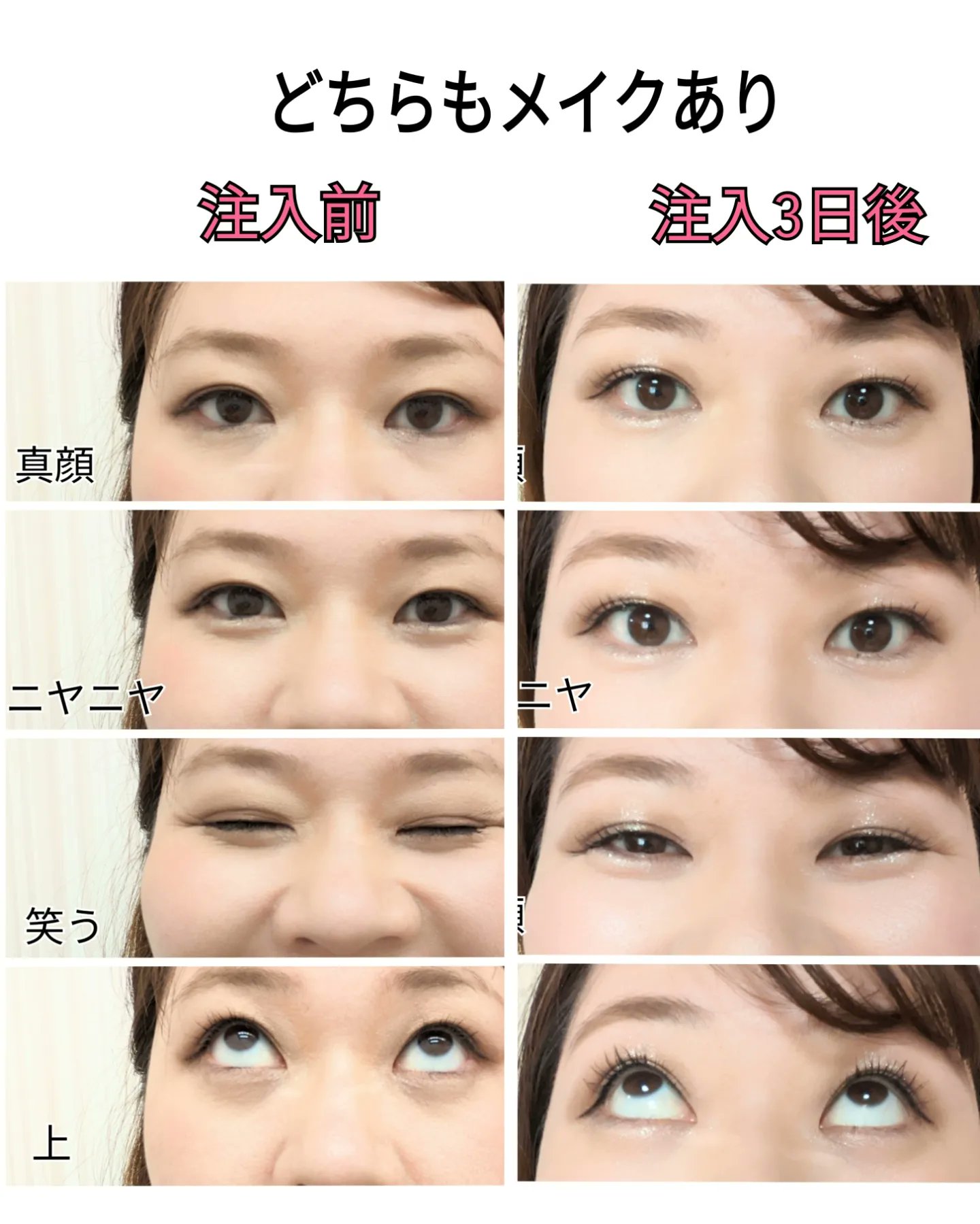 涙袋形成 Twitter Search Twitter