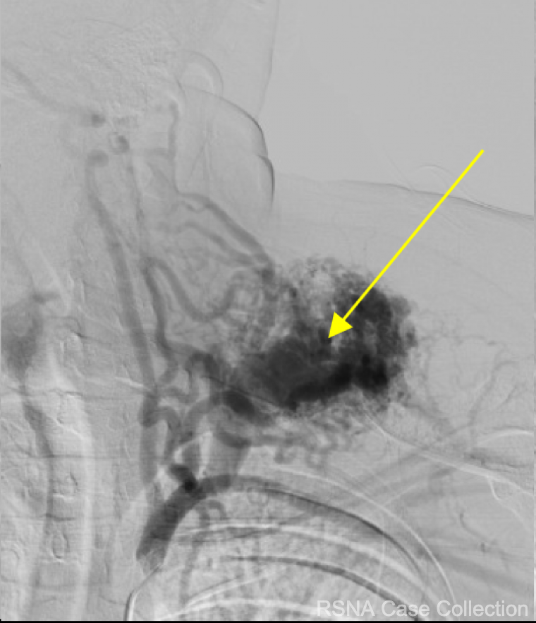RCC_Editor's tweet photo. Try this great #RadRes Case-of-the-Week!
What’s the diagnosis in this 34 yo woman with left sided neck pain &amp; left upper/lower extremity numbness? 
https://t.co/YCgZlI3h3L

@AATSHQ @atscommunity @accpchest @ERSpublications @STS_CTsurgery
#radtwitter https://t.co/gx3dbSrw40