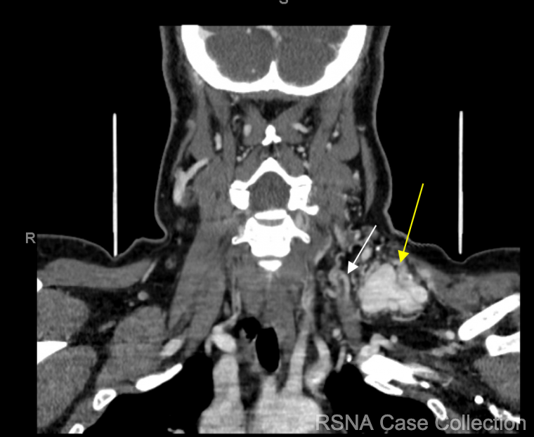 RCC_Editor's tweet photo. Try our new #ChestRad Case-of-the-Week!  
What’s the diagnosis in this 34 yo woman with left sided neck pain &amp; left upper/lower extremity numbness? 
https://t.co/YCgZlI3h3L

@RSNA @thoracicrad @ESTI_Society @BSTImaging @ASHNRSociety
#RSNACC https://t.co/31cog25Wc2