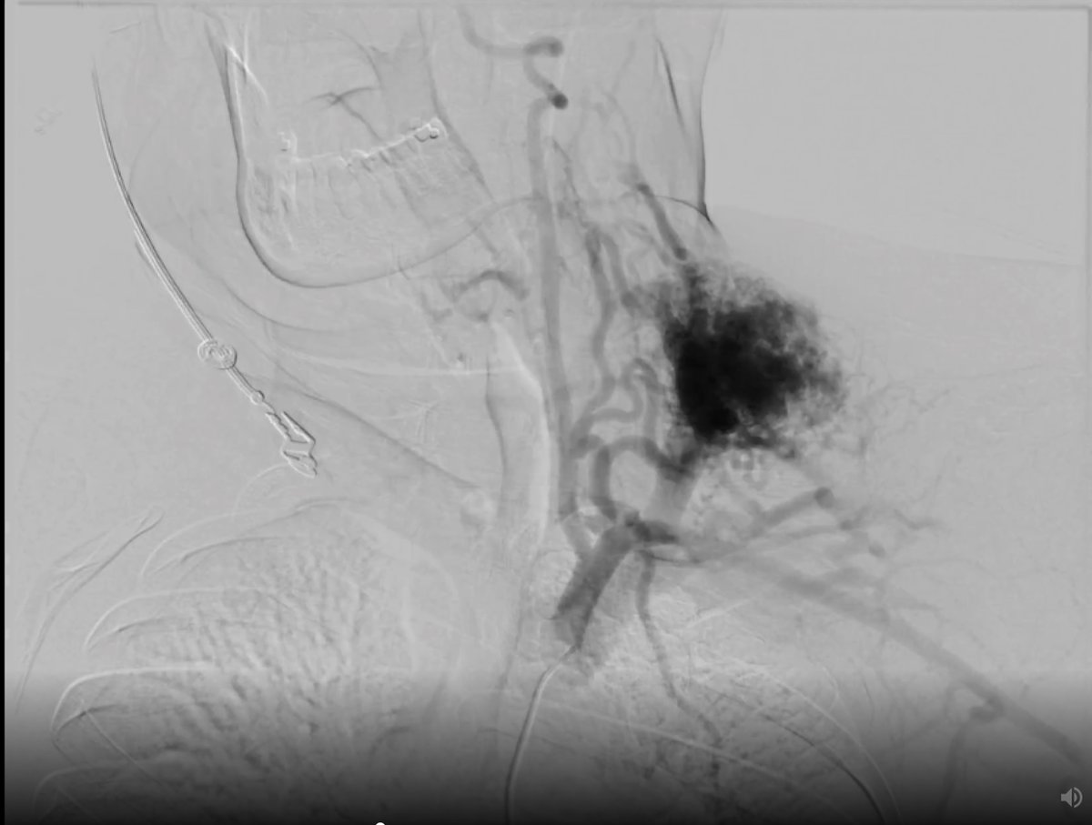 RCC_Editor's tweet photo. Try our new #ChestRad Case-of-the-Week!  
What’s the diagnosis in this 34 yo woman with left sided neck pain &amp; left upper/lower extremity numbness? 
https://t.co/YCgZlI3h3L

@RSNA @thoracicrad @ESTI_Society @BSTImaging @ASHNRSociety
#RSNACC https://t.co/31cog25Wc2