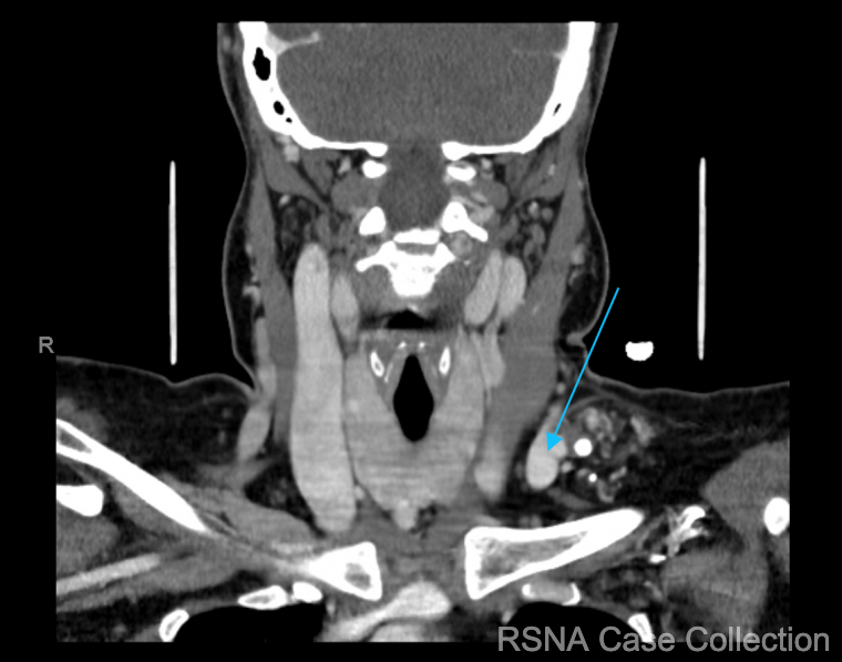 RCC_Editor's tweet photo. Try our new #ChestRad Case-of-the-Week!  
What’s the diagnosis in this 34 yo woman with left sided neck pain &amp; left upper/lower extremity numbness? 
https://t.co/YCgZlI3h3L

@RSNA @thoracicrad @ESTI_Society @BSTImaging @ASHNRSociety
#RSNACC https://t.co/31cog25Wc2