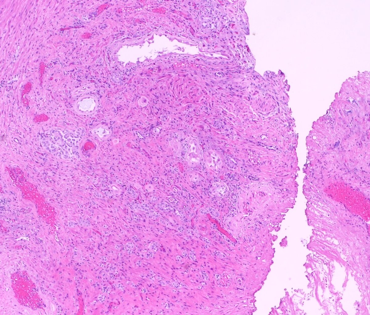 Teclis82's tweet photo. #GUPath #Surgpath #Pathresidents  

70 Year old man; TURP for BPH:

A few images, a poll, and a short annotated discussion. https://t.co/kCbvfG2bjz