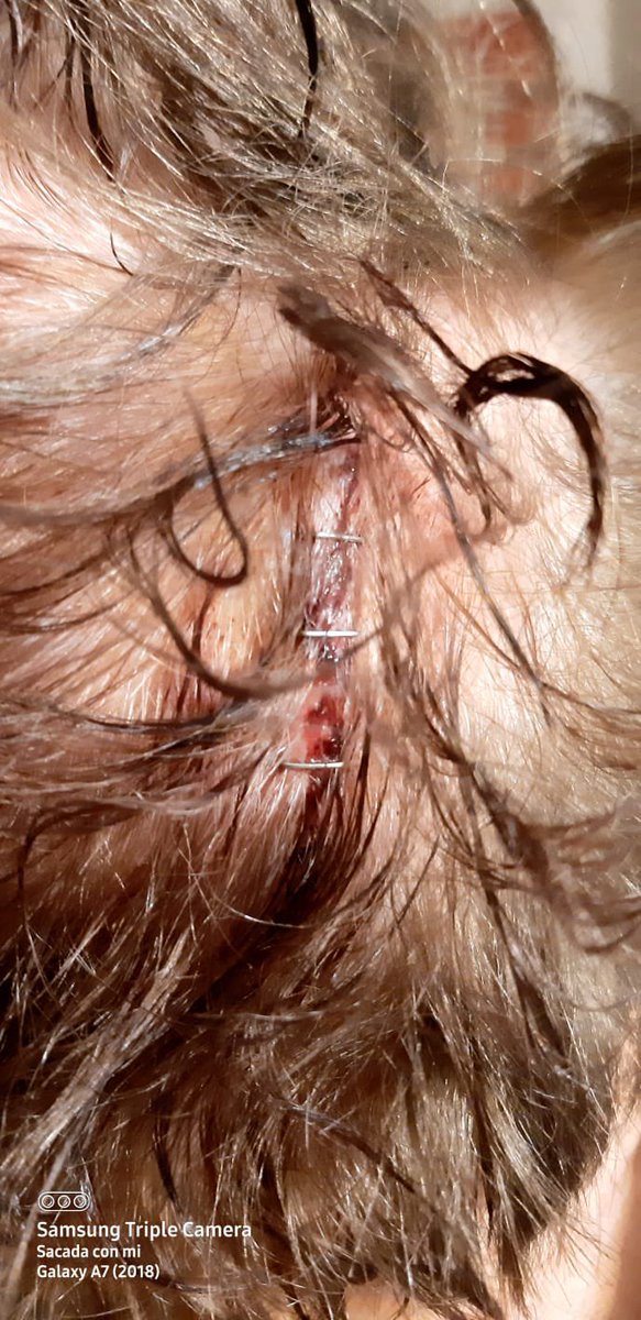 Mireiatxispi's tweet photo. @Hospitaligd no teniu vergonya. Aquesta és la “cura”que li vau fer ahir a urgències a la meva iaia de 99 anys. Medicina de guerra? No! Molt pitjor . Ni netejat, cabells enganxats i molt mal. @ajigualada @salutcat @Hospitaligd  ni professional ni humà qui li va fer aquesta carnice https://t.co/h1yIt40lay