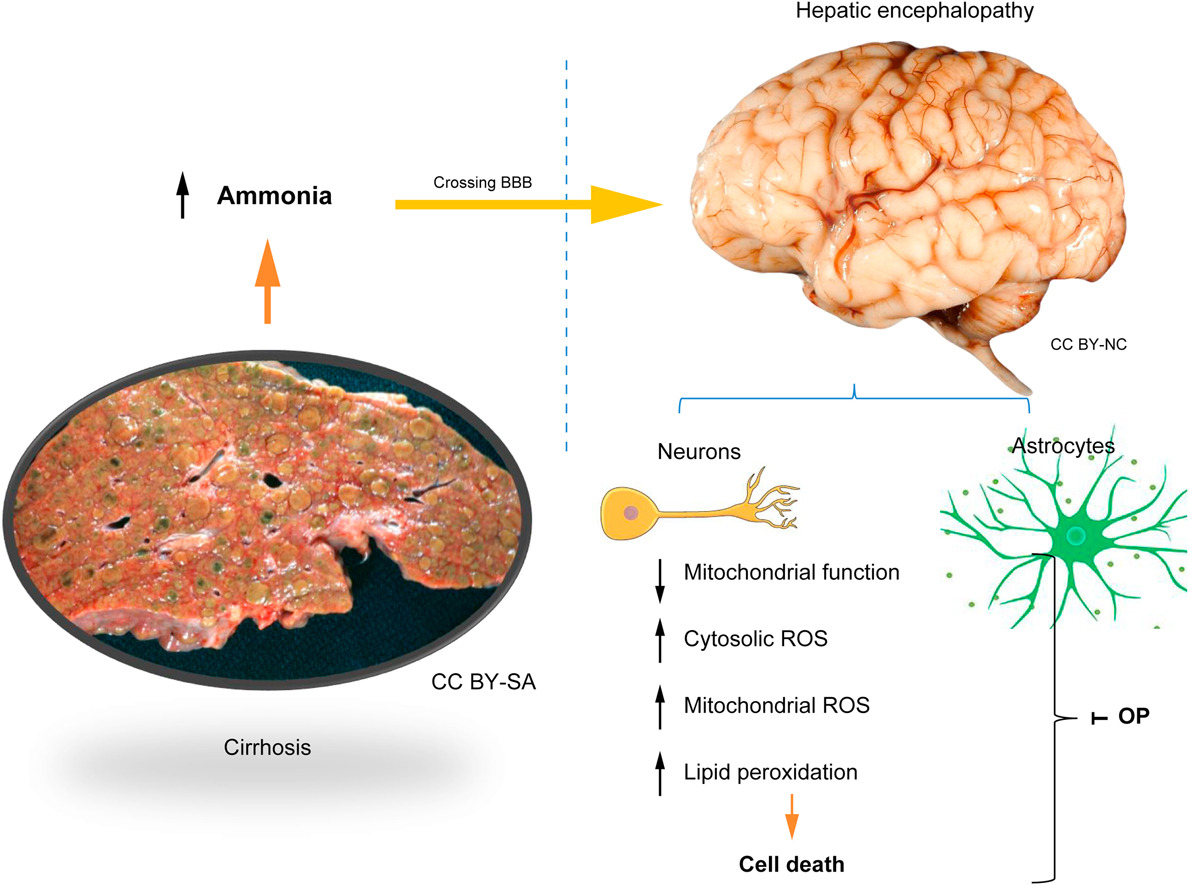 #Hyperammonaemia in patients with #cirrhosis induces ➡️mitochondrial dysfunction ➡️overproduction of #ReactiveOxygenSpecies ➡️#celldeath in primary neurons 🔓#OpenAccess at👉bit.ly/3ntTC5k @RajivJalan1 #LiverTwitter