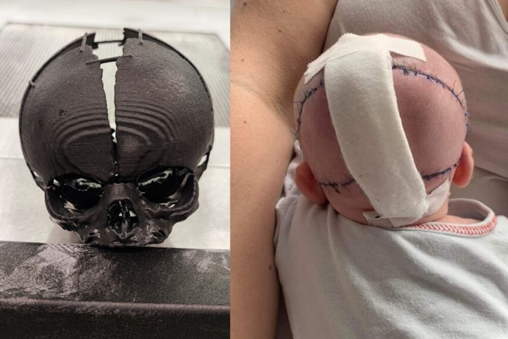 divisionxc's tweet photo. Warsaw Tech Company Saves Life of Baby Born with Undeveloped Cranium after Printing 3D Skull.
How amazing is it to be involved in an industry that can do so much good.
Read the full story https://t.co/5LcwPJ2ANs
#3dprinting #3dprintedskull #3dprintedbabyskull #flashforgefoto8 https://t.co/J5Y46O7Csq