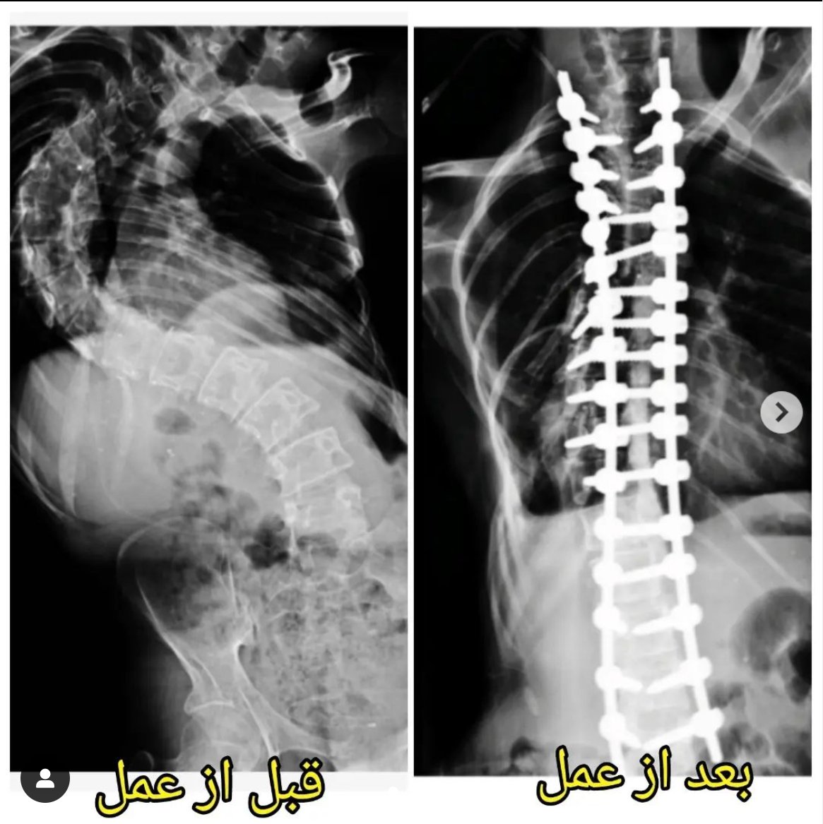 SpineYas's tweet photo. جراحی های سنگین مثل این جراحی انحراف 106 درجه ای، حاصل همکاری متخصصین رشته های دیگه ای مثل بیهوشی و ریه و جراحی توراکس با جراح ستون فقراته و بدون این همکاری ممکن نیست،  ولی افتخار می کنیم که دکتر محسن رستمی، جراح این بیمار از همکاران ما در مرکز یاس هستن https://t.co/6vIka2Vt4x