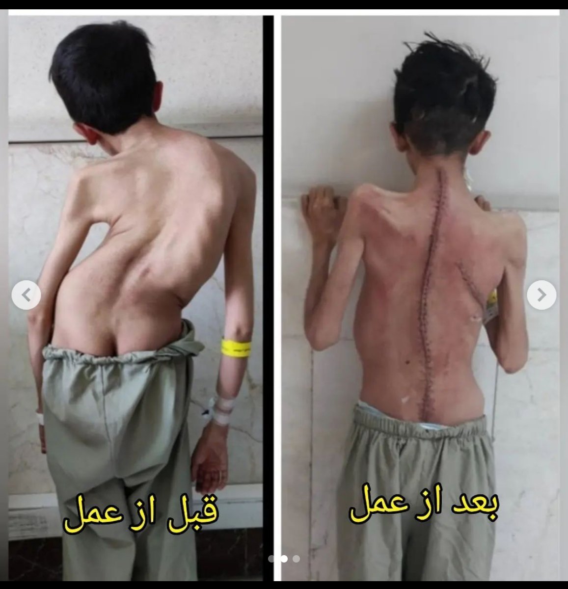 SpineYas's tweet photo. جراحی های سنگین مثل این جراحی انحراف 106 درجه ای، حاصل همکاری متخصصین رشته های دیگه ای مثل بیهوشی و ریه و جراحی توراکس با جراح ستون فقراته و بدون این همکاری ممکن نیست،  ولی افتخار می کنیم که دکتر محسن رستمی، جراح این بیمار از همکاران ما در مرکز یاس هستن https://t.co/6vIka2Vt4x