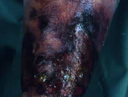 I’m tired of physicians and other providers using dark skin as an excuse for being unable to assess whether a patient has an NSTI. Necrosis is not obscured by skin tone. Anyone can tell that this is abnormal and dead (📸 DermNet)