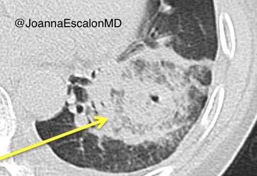JoannaEscalonMD's tweet photo. Case of the Mondays: Two different patients with reverse halo sign —> both pulmonary mucormycosis. RHS is highly suggestive of PM in neutropenic leukemia patients. @WCMRadRes #chestrad #radres https://t.co/Yf6zJ9uLYj