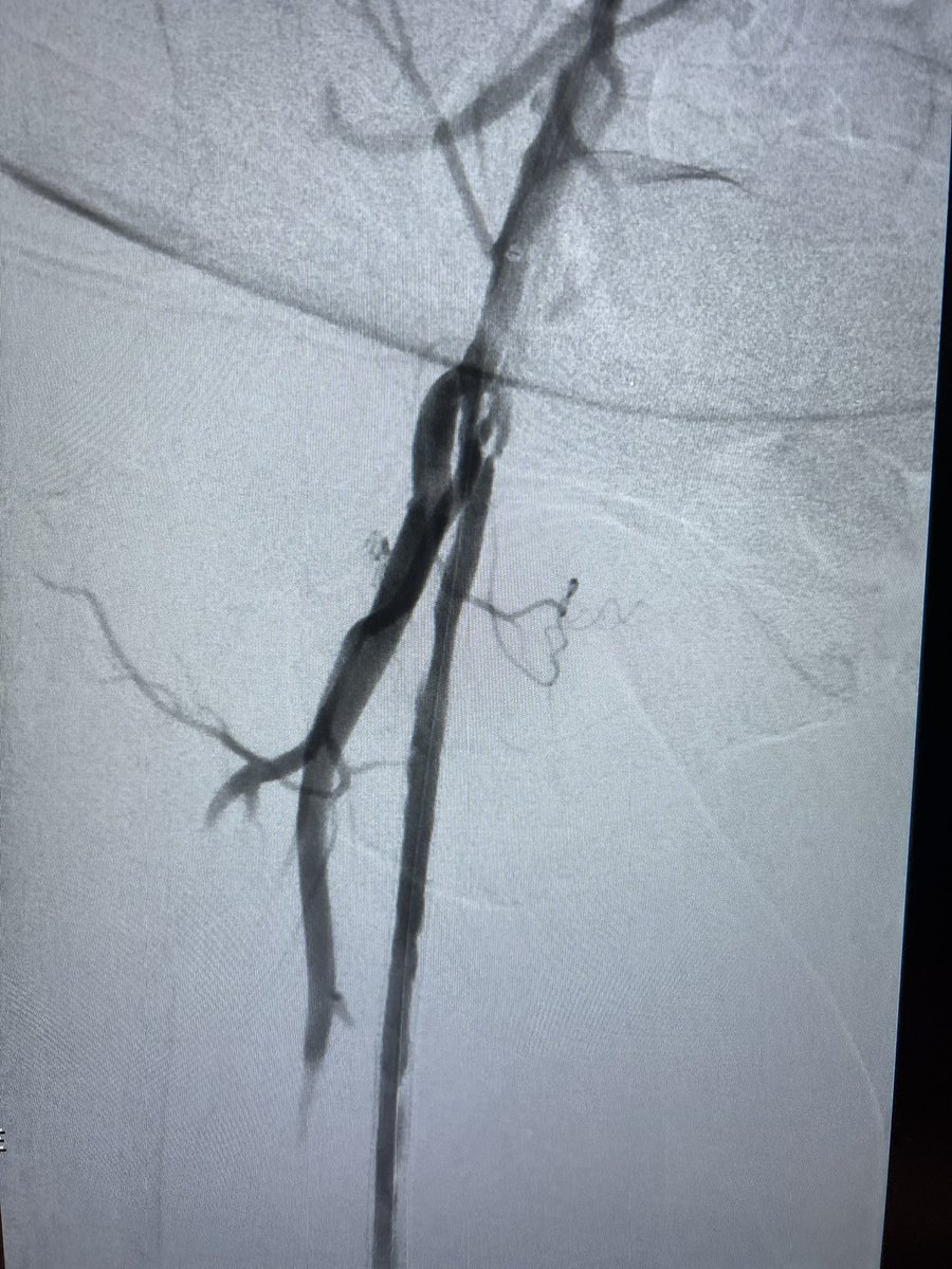 DrAmirKaki's tweet photo. 68 year old patient with rest pain.  Flush occlusion of SFA Viabahn stent that is 10 years old.  Ambiguous cap that required flip and stick.  Successfully treated with thrombectomy and IVUS guided PTA.  First thrombectomy experience with Prodigy by Truvic. All 5F in the OBL https://t.co/kSaxBpj88m