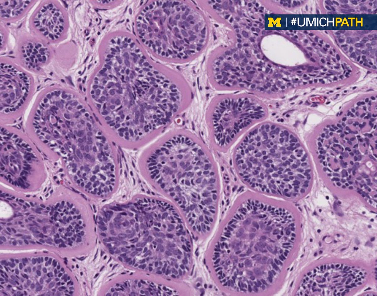 Here is this week's #CaseOfTheWeek from <a href="/JasmineSaleh/">Jasmine Saleh, MD MPH</a> of #UMichPath.

25 y.o. F presents with multiple tumors on her scalp. Shave biopsy performed.

What is your diagnosis? 

What syndrome may it be associated with?

Answers to be shared on Friday!

#PathTwitter