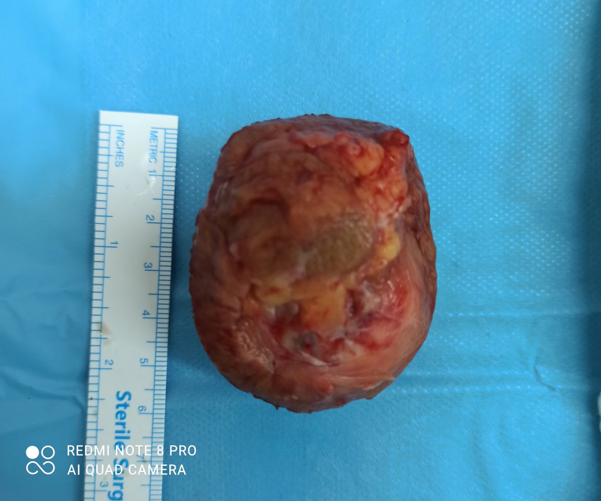 Mohammad Yasir SAHAK (@sahakyasir) on Twitter photo Left Partial nephrectomy
Case : 42 yo/ ♂️
posterior located left renal mass (5.5 cm) with accessory artery and vein
<a href="/ytanidir/">Yiloren Tanidir</a> <a href="/MarmaraUroloji/">M.Ü.T.F. Üroloji A.D.</a> <a href="/drbahadirsahin/">Bahadır Şahin</a> <a href="/sertc_saracogl/">Sertaç Saraçoğlu</a> Left Partial nephrectomy
Case : 42 yo/ ♂️
posterior located left renal mass (5.5 cm) with accessory artery and vein
<a href="/ytanidir/">Yiloren Tanidir</a> <a href="/MarmaraUroloji/">M.Ü.T.F. Üroloji A.D.</a> <a href="/drbahadirsahin/">Bahadır Şahin</a> <a href="/sertc_saracogl/">Sertaç Saraçoğlu</a>