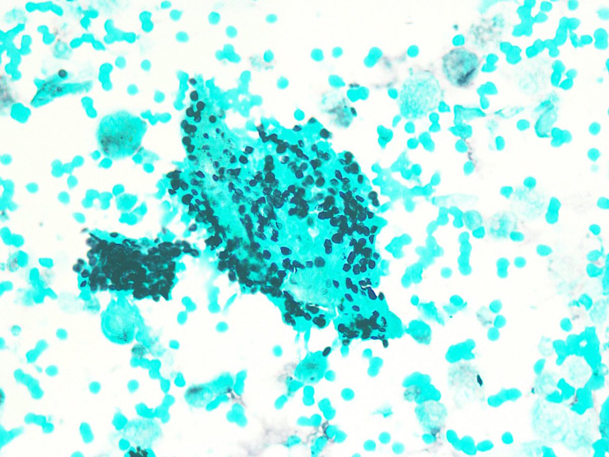 Yalwelaie's tweet photo. Bronchoalveolar lavage showing numerous pneumocystis organisms and cytomegalovirus inclusions in a severely immunocompromised pt. #CytoPath https://t.co/QPcTIj5o0U