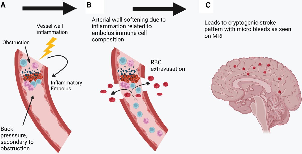 Stroke AHA/ASA on Twitter "ICYMI SpecialReport Dr. Meaney et al