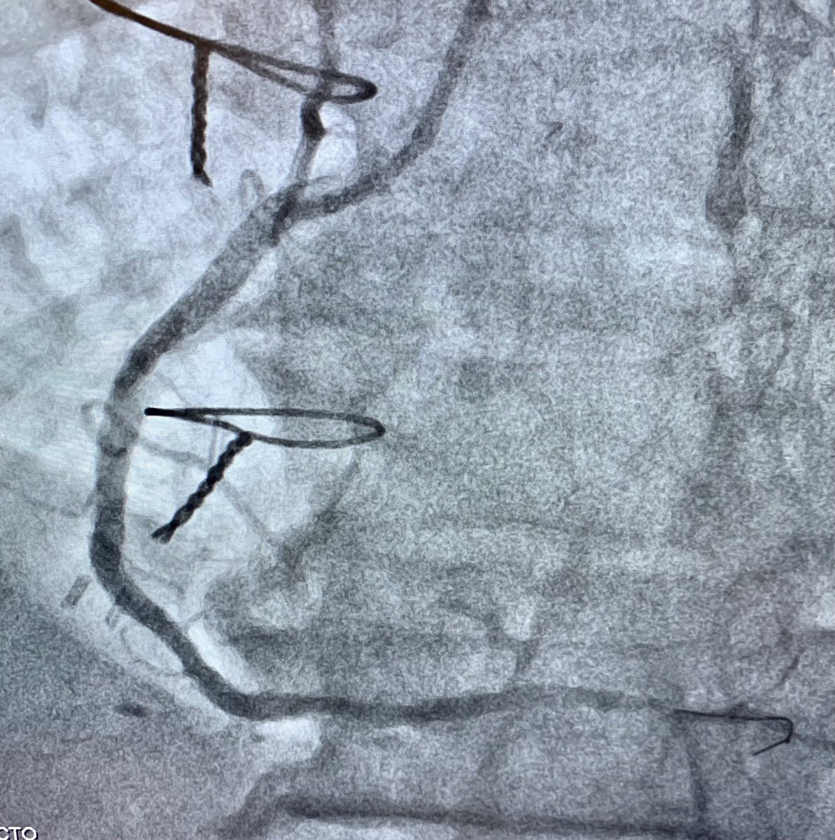 jcgeorgemd's tweet photo. #CTOPCI at #PennsyInterventions: sometimes bridging collaterals with antegrade flow can appear straightforward but deceiving!  Failed prior attempt at OSH. Eventually successful here with ADR and rotational atherectomy with IVUS guidance. @PennCardiology @PennCVFellows @ReVascMed https://t.co/0iApBJchPK