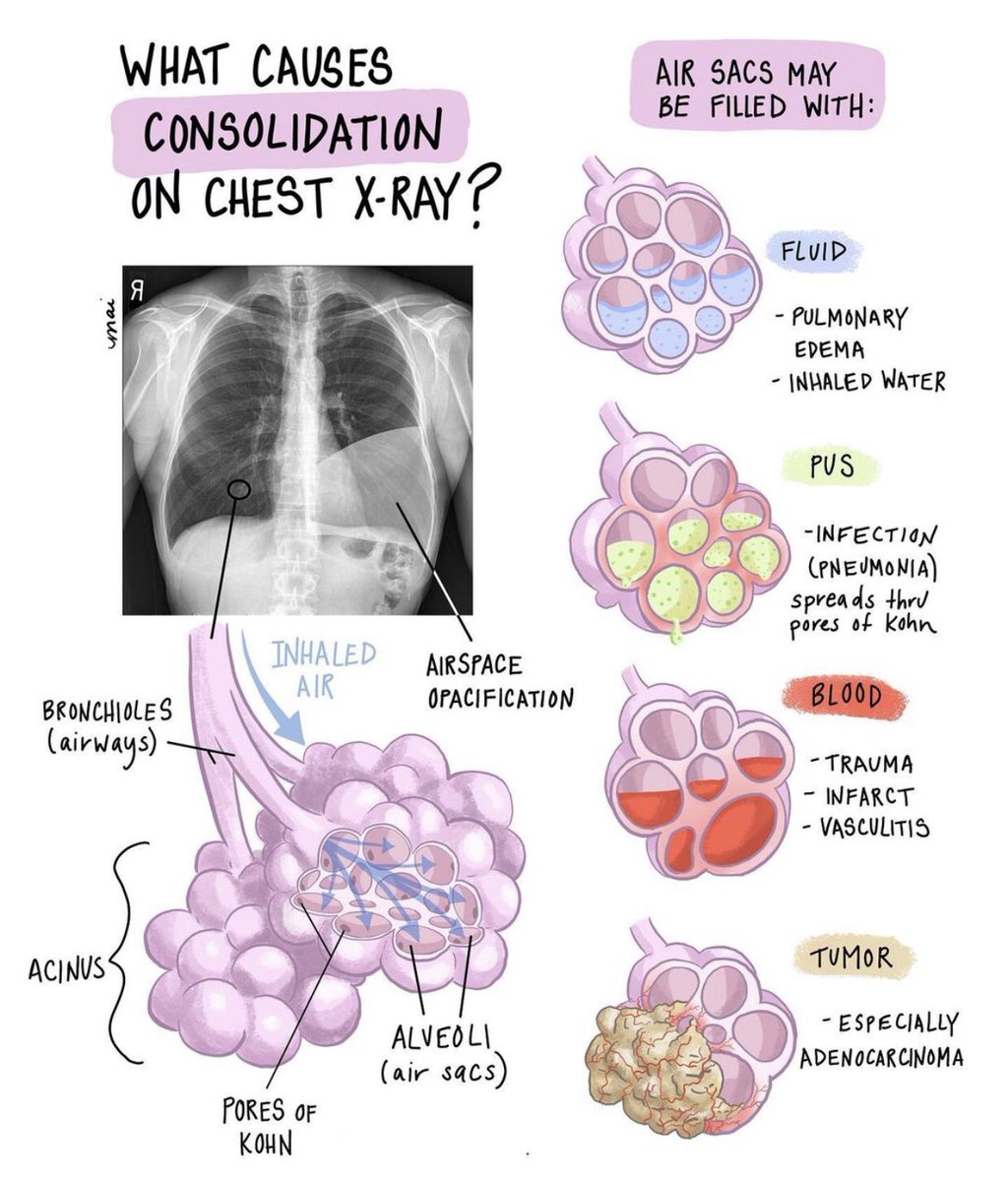 Medical_MD1's tweet photo. FlashNote 🫁 🤩

Consolidation happens due when air in the alveoli is replaced by transudate, pus, blood, cells or other substances

Here you’ll see the 
Differential Diagnosis and types of Lung consolidations on a chest X-ray✨

. https://t.co/ixYPfzt2cW