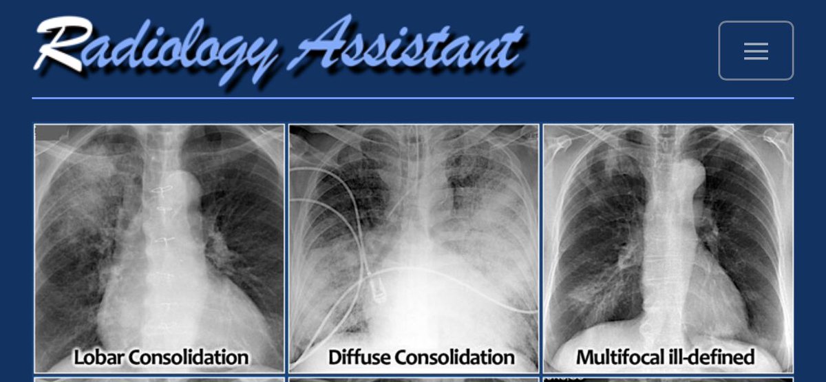 Medical_MD1's tweet photo. FlashNote 🫁 🤩

Consolidation happens due when air in the alveoli is replaced by transudate, pus, blood, cells or other substances

Here you’ll see the 
Differential Diagnosis and types of Lung consolidations on a chest X-ray✨

. https://t.co/ixYPfzt2cW