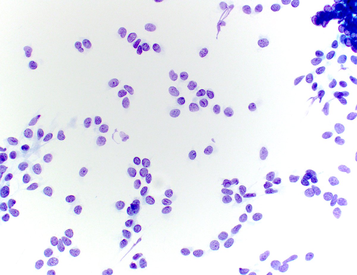 PathIsArt's tweet photo. This is another impromptu #cytology smear made from an ovarian mass in a middle-age patient that came for #intraop consultation. What diagnosis comes to mind? What features give it away? 👀🔬 #cytopath #gynpath #PathTwitter https://t.co/VdRrkjlHMK