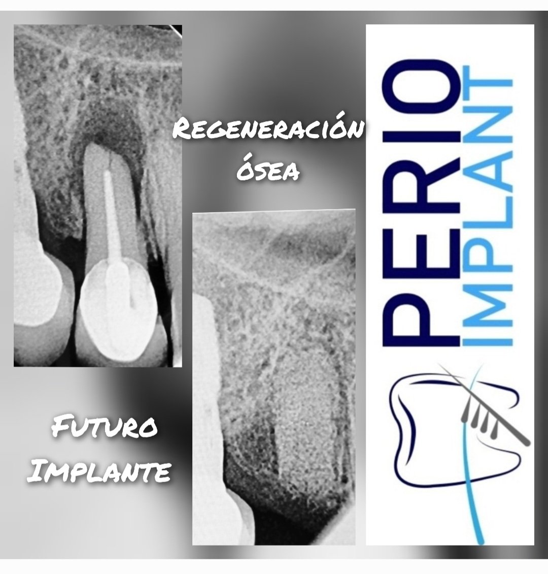 avendanodr's tweet photo. Daily Floss News 396. Extracciòn de pieza fracturada, regeneración òsea guiada por medio de injerto de hueso bovino (orthogen) y membrana de pericardio (techgraf). Preparando sitio para futuro implante. #mismeetteam, #misimplants, #perioimplant, #avendanodr https://t.co/W9bDo2EiOk