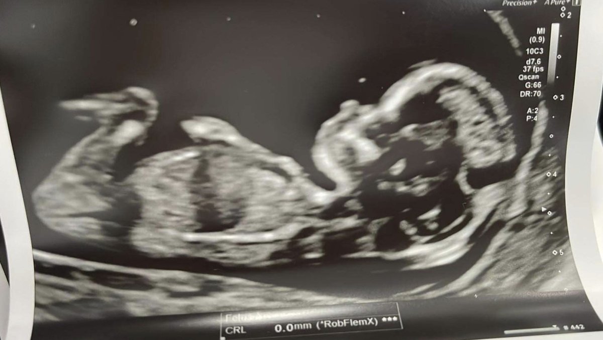 claredaz99's tweet photo. How I've kept this a secret for so long, I just don't know ๐คฃ huge congratulations to our son Charlie and his fiancรฉe Whitney who are expecting their first baby ๐ฅฐ our first grandchild due March 2023. Absolutely over the moon ๐ถ #firstgranchild #nanny #grandad https://t.co/fVy5VswuKz