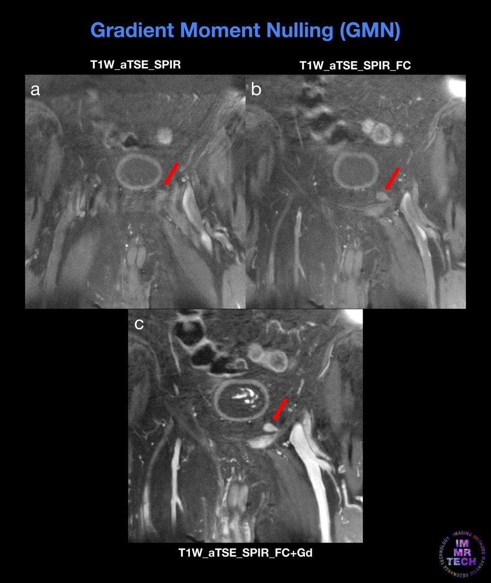 immrtech's tweet photo. Flow Compensation (FC) is a method to reduce flow artifacts. In this pelvic MRI case, note how FC benefits the final image, showing pathology (confirmed in panel c after contrast agent injection) that otherwise wouldn’t be visible (panel a, b, before and after FC, respectively). https://t.co/JmoZPmHuXo