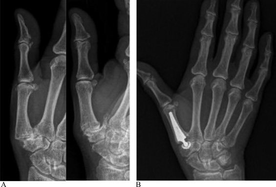 OrthopodReg's tweet photo. Time for some teeny tiny arthroplasty!
#orthotwitter #medtwitter https://t.co/84wItXzyei