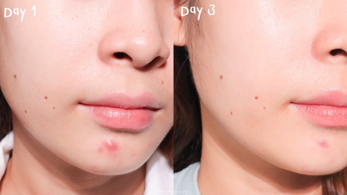 MyLittlePleng's tweet photo. เวลาเป็นสิวก็อยากได้ไอเทมลดสิวดีๆสบายๆหน้ามาใช้ Garnier Acne Serum เริ่ดอยู่นะ เนื้อบางเบา ช่วยชีวิตคนเป็นสิวเว่อ หลังใช้สิวยุบไว ไม่อักเสบเพิ่ม ไม่ค่อยทิ้งรอยสิว หน้าดูไบรท์ขึ้นด้วยอ่ะ ใช้กับโฟมในไลน์เดียวกันยิ่งเริ่ดx2 ไปลองๆ #เซรั่มสู้สิวอัพผิวไบรท์ #ไว้รีวิวห้ามขายของโว้ยย https://t.co/Z94FNCdZ5w