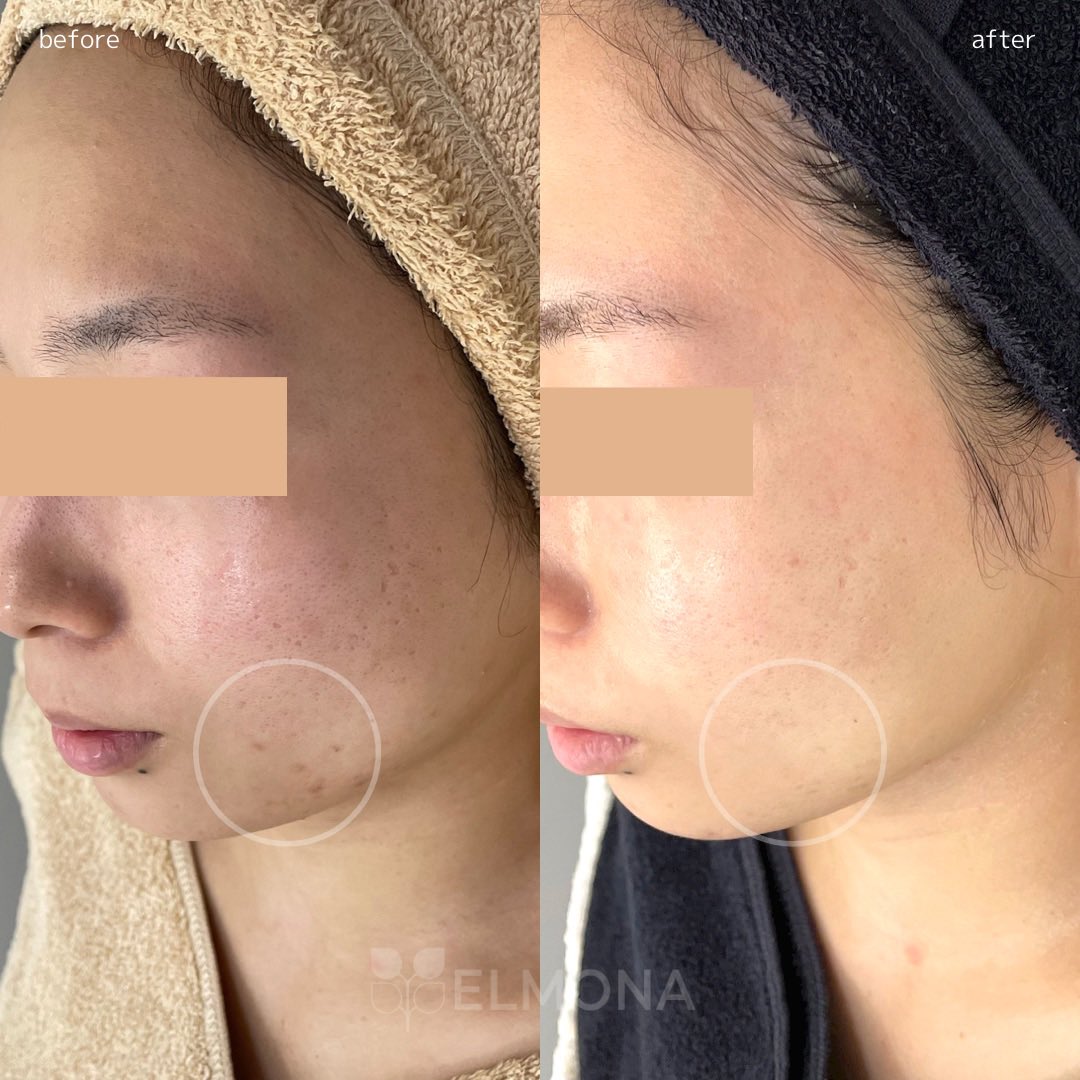 ハーブピーリング グリンピール 松戸newオープン