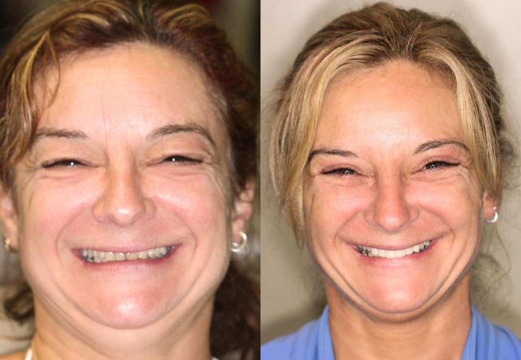 Before Ana came to Dr. Lampee, her teeth were worn, stained and full of leaking fillings. Her Lampee Rejuvenation – featuring six front porcelain crowns – is simply breathtaking. She loves her new smile, and so do we!

#DrLampee #DrLampeeImplants #Veneers #Dentistry