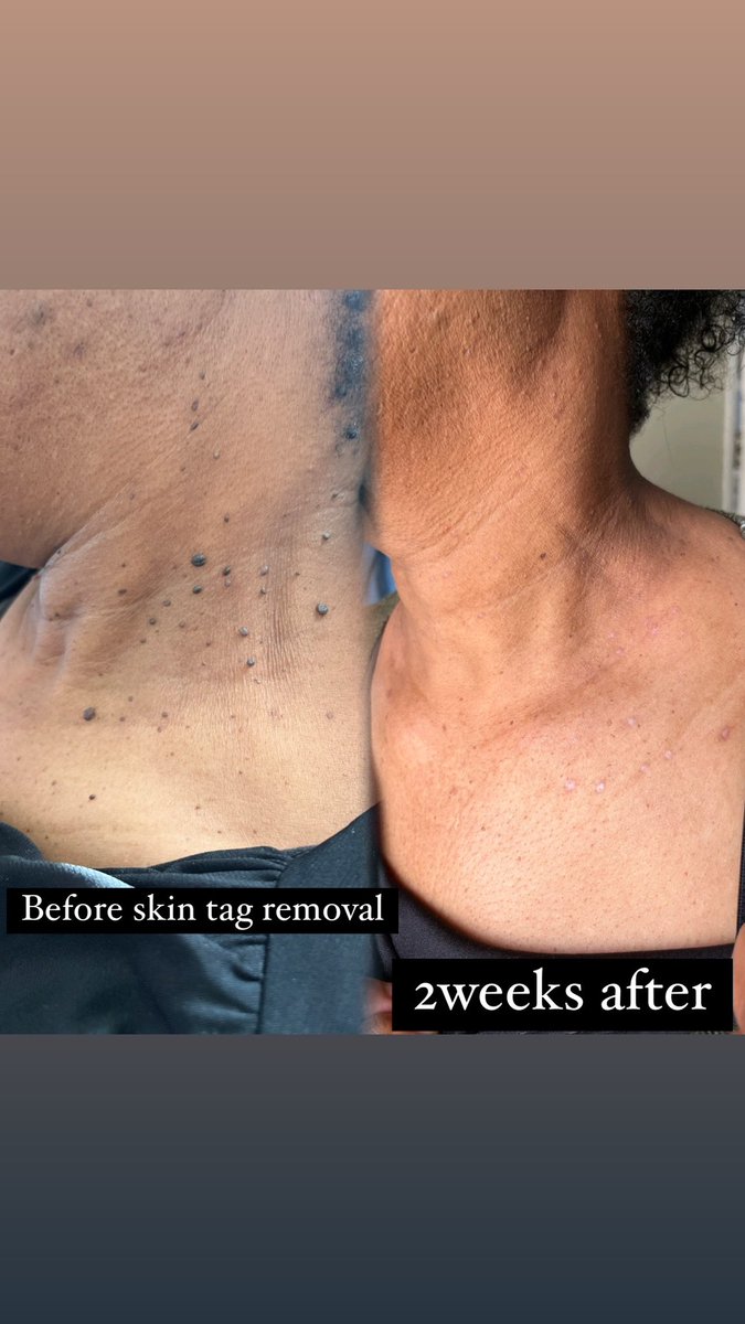 flick_that's tweet photo. Skin Tag Removal!
Procedure;
Pain-0% Numbing cream used (30-45min before procedure)
Time-30min or more
Cost- R600 per 30min

#HaveFaith #GirlTalkZA #podcastandchillwithmacg # https://t.co/SzbHRgOr8g