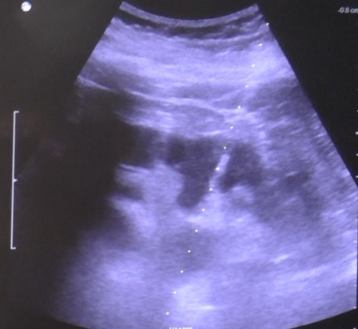 preetihospital's tweet photo. #Solitarykidney
Failed #URSL attempt outside
Creatinine 8
Meaty kidney
Minimal dilatation
Usg guided puncture in such kidney is difficult.
Sharing one such video.
https://t.co/zZ9ie01l0R
#vcmohan #urology @preetihospital #KidneyDisease #usg https://t.co/cRB71w3z4T