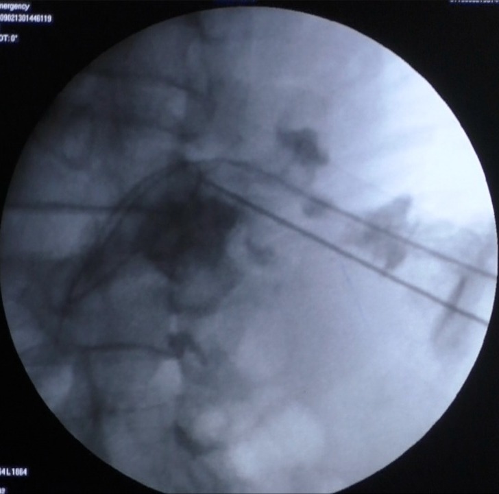 preetihospital's tweet photo. #Solitarykidney
Failed #URSL attempt outside
Creatinine 8
Meaty kidney
Minimal dilatation
Usg guided puncture in such kidney is difficult.
Sharing one such video.
https://t.co/zZ9ie01l0R
#vcmohan #urology @preetihospital #KidneyDisease #usg https://t.co/cRB71w3z4T