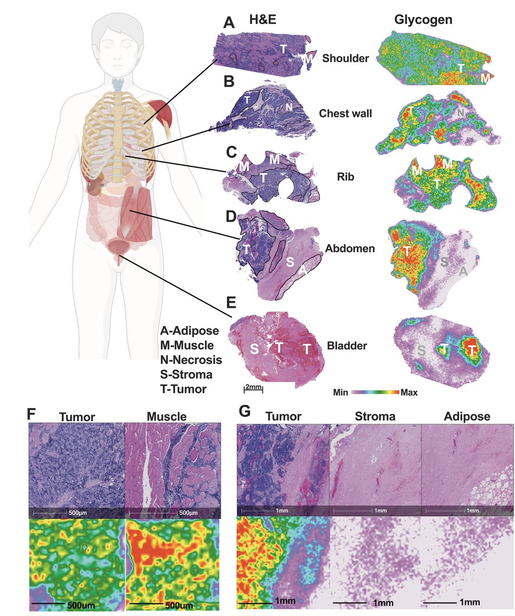 Very excited to see the bulk of my Ph.D. work published in EMBO Mol Med! Using spatial glycogen quantitation, we revealed a new therapeutic target for Ewing sarcoma! Cheers guys! 🎉👩‍🔬💙 @lindsey_conroy <a href="/T_Hawkinson/">Tara</a> <a href="/RCSunlab/">Ramon Sun</a> <a href="/metsfan_matt/">Matt Gentry</a> <a href="/DrakeLabMUSC/">Drake Lab</a> 

embopress.org/doi/epdf/10.15…