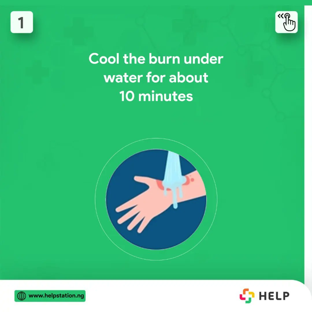 help_station_'s tweet photo. A burn is an injury to the skin or other organic tissues, primarily caused by heat due to fire, hot liquids, steam etc  These are some tips on what to do in a burns situation.

#HELPonthego #HELPisontheway #emergencyservices #emergencysercicesinlagos #emergencyservicesinnigeria https://t.co/ajsRhcu546