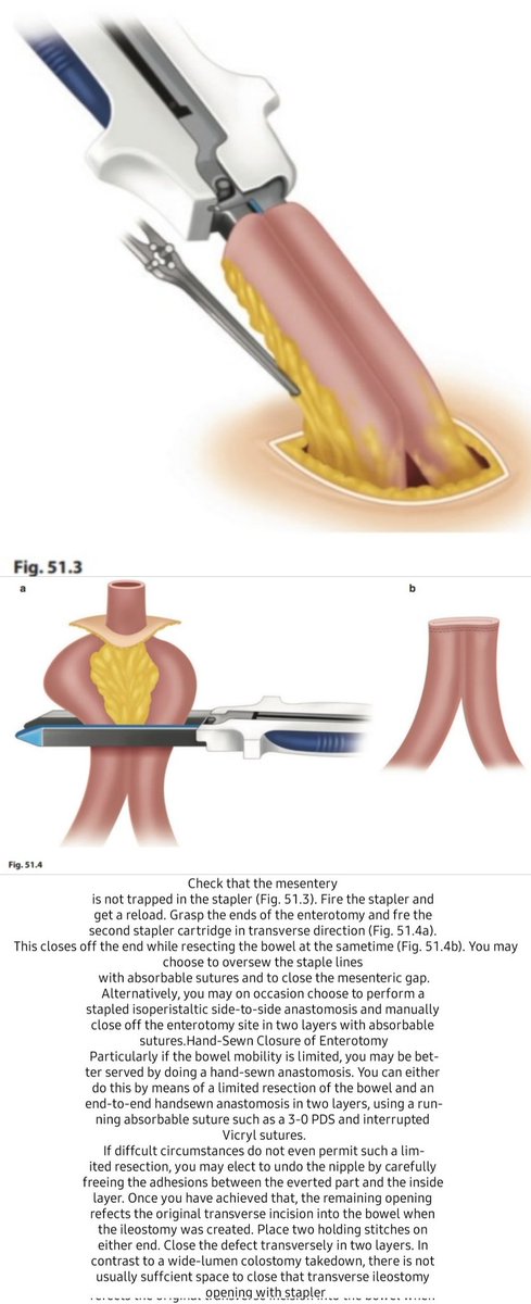 DRAFTABAHMED7's tweet photo. Closure of Loop Ileostomy
(Indications,Contraindications, Pitfalls &amp; Danger Points, Preop Preparation,Operative Technique, Management of Skin Wound Operative Strategy,Postop Care, Complications
𝗥𝗲𝗳:Chassin’s Operative Strategy in General Surgery, An Expositive Atlas, 2022 https://t.co/Dqqp6wwQM5