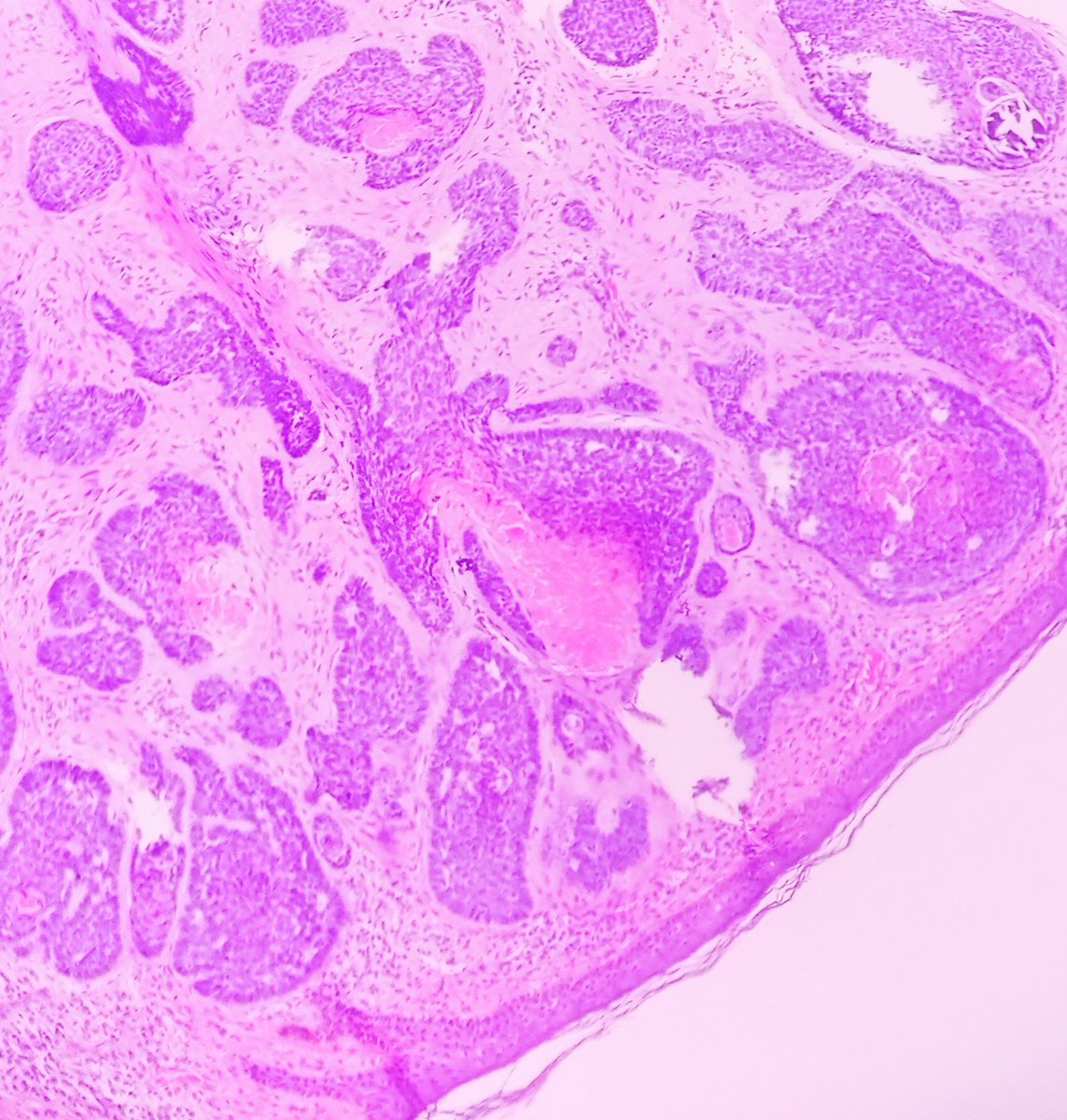 Prachi (@prachipath123) on Twitter photo AUNTMINI IN PATHOLOGY- BCC-NODULAR TYPE- ADENOID VARIANT. @IsabellaDishong <a href="/DrGeeONE/">Olaleke Folaranmi</a> <a href="/dr_amenona/">Aswathy Menon Ananthvikas</a> <a href="/DrAnilaSharma1/">Dr Anila Sharma</a> <a href="/mathuraiims/">Sandeep Mathur</a> <a href="/AnnieAWu/">Annie A. Wu, MD, PhD</a> <a href="/Daisymdpath/">Daisy Maharjan</a> <a href="/archibhat3/">Archana bhat</a> <a href="/Swathiprabhu5/">Swathi Prabhu, MD</a> <a href="/DrAruDeb/">Arunima Deb, MD</a> <a href="/adi_agnihotri/">Aditya Agnihotri 🇮🇳</a> <a href="/VijayPatho/">Vijay Shankar S</a> <a href="/Daisymdpath/">Daisy Maharjan</a> <a href="/Chucktowndoc/">Frank Ingram, MD</a> <a href="/Dob_Steino/">Dante</a> <a href="/FlyFan7/">fanbotao</a> <a href="/FTTUD4D3cm5uUNX/">Ygl</a> AUNTMINI IN PATHOLOGY- BCC-NODULAR TYPE- ADENOID VARIANT. @IsabellaDishong <a href="/DrGeeONE/">Olaleke Folaranmi</a> <a href="/dr_amenona/">Aswathy Menon Ananthvikas</a> <a href="/DrAnilaSharma1/">Dr Anila Sharma</a> <a href="/mathuraiims/">Sandeep Mathur</a> <a href="/AnnieAWu/">Annie A. Wu, MD, PhD</a> <a href="/Daisymdpath/">Daisy Maharjan</a> <a href="/archibhat3/">Archana bhat</a> <a href="/Swathiprabhu5/">Swathi Prabhu, MD</a> <a href="/DrAruDeb/">Arunima Deb, MD</a> <a href="/adi_agnihotri/">Aditya Agnihotri 🇮🇳</a> <a href="/VijayPatho/">Vijay Shankar S</a> <a href="/Daisymdpath/">Daisy Maharjan</a> <a href="/Chucktowndoc/">Frank Ingram, MD</a> <a href="/Dob_Steino/">Dante</a> <a href="/FlyFan7/">fanbotao</a> <a href="/FTTUD4D3cm5uUNX/">Ygl</a>