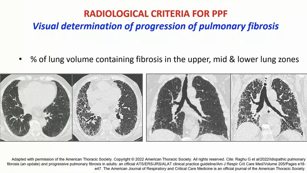 drdayjee's tweet photo. Emphasizes that quantitative assessment of HRCT fibrosis is fast evolving with the advent of AI technology becoming increasingly available. 

#ERS2022 https://t.co/KrgycHdwhG
