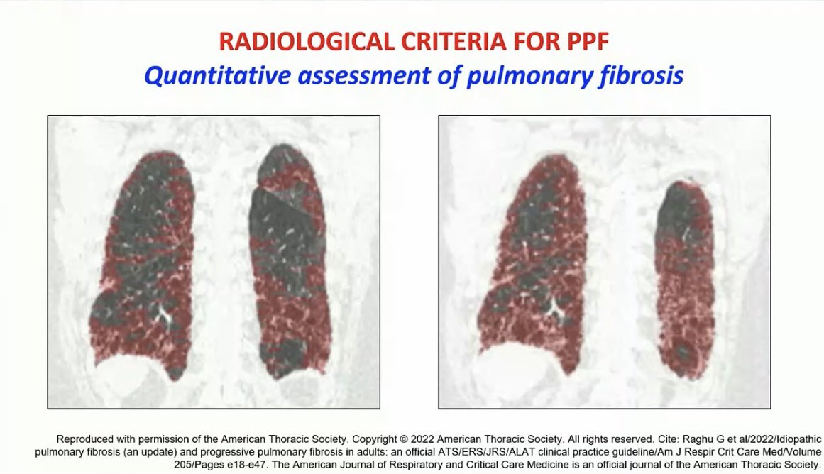drdayjee's tweet photo. Emphasizes that quantitative assessment of HRCT fibrosis is fast evolving with the advent of AI technology becoming increasingly available. 

#ERS2022 https://t.co/KrgycHdwhG