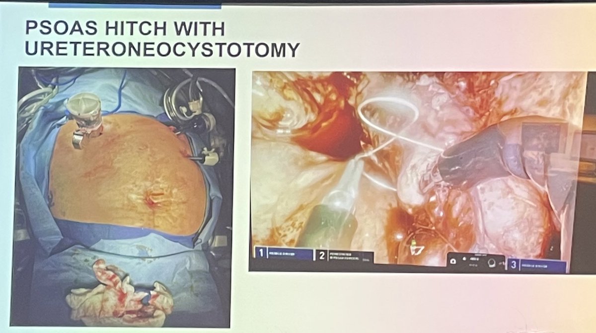 Florida Urological Society (FUS) (@flaurological) on Twitter photo Dr. Raymond Pak, Chair at Mayo Clinic Florida <a href="/MayoFL_UrolRes/">Mayo Clinic FL Urology Residency</a> gives an enlightening talk on his experience with single port robotics and highlights the utility of this platform in a hostile abdomen #FUS2022 Dr. Raymond Pak, Chair at Mayo Clinic Florida <a href="/MayoFL_UrolRes/">Mayo Clinic FL Urology Residency</a> gives an enlightening talk on his experience with single port robotics and highlights the utility of this platform in a hostile abdomen #FUS2022